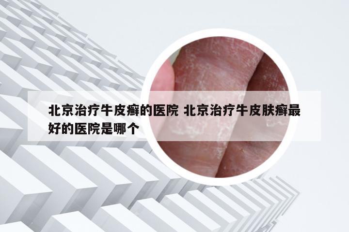 北京治疗牛皮癣的医院 北京治疗牛皮肤癣最好的医院是哪个