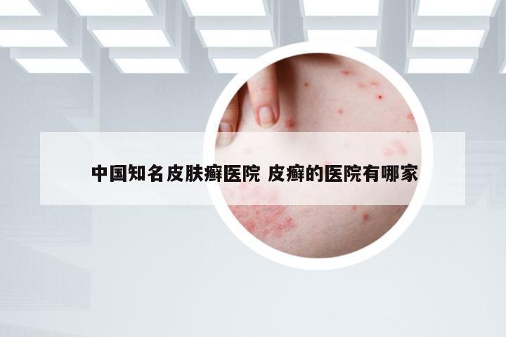 中国知名皮肤癣医院 皮癣的医院有哪家