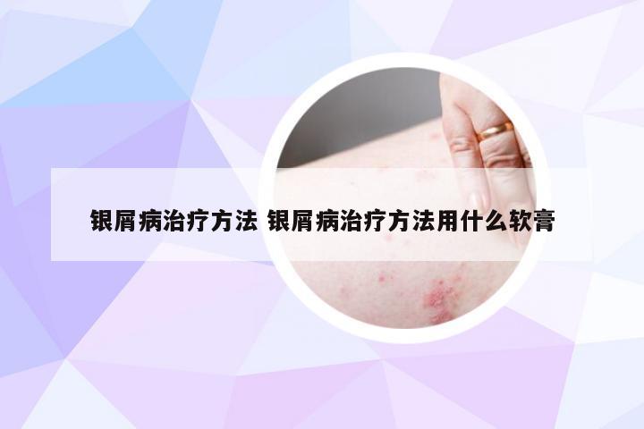银屑病治疗方法 银屑病治疗方法用什么软膏