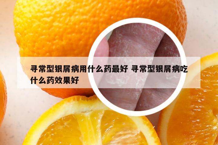 寻常型银屑病用什么药最好 寻常型银屑病吃什么药效果好