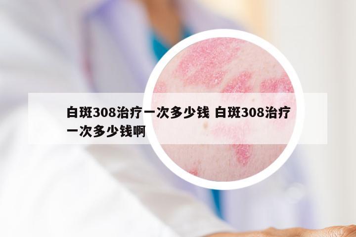 白斑308治疗一次多少钱 白斑308治疗一次多少钱啊