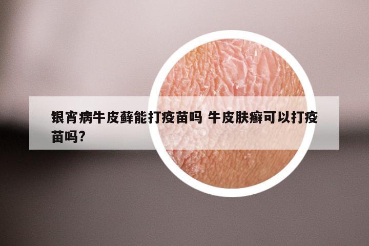 银宵病牛皮藓能打疫苗吗 牛皮肤癣可以打疫苗吗?