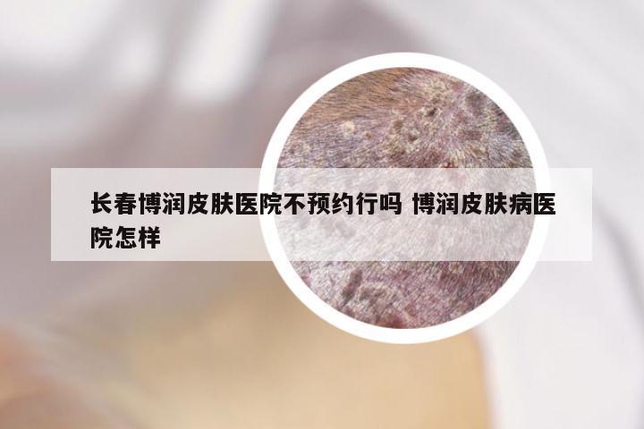 长春博润皮肤医院不预约行吗 博润皮肤病医院怎样