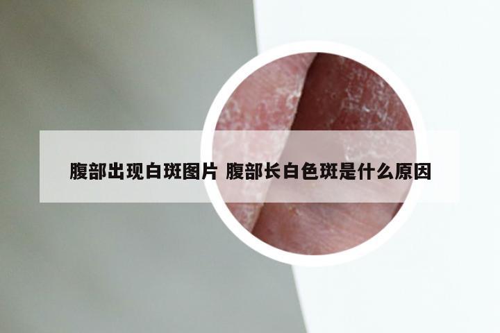 腹部出现白斑图片 腹部长白色斑是什么原因