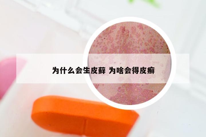 为什么会生皮藓 为啥会得皮癣