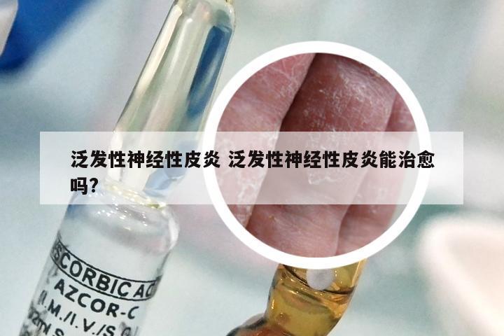 泛发性神经性皮炎 泛发性神经性皮炎能治愈吗?