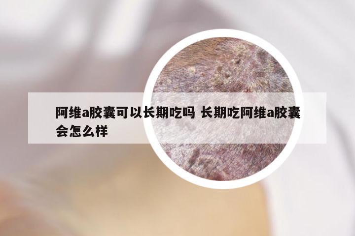 阿维a胶囊可以长期吃吗 长期吃阿维a胶囊会怎么样