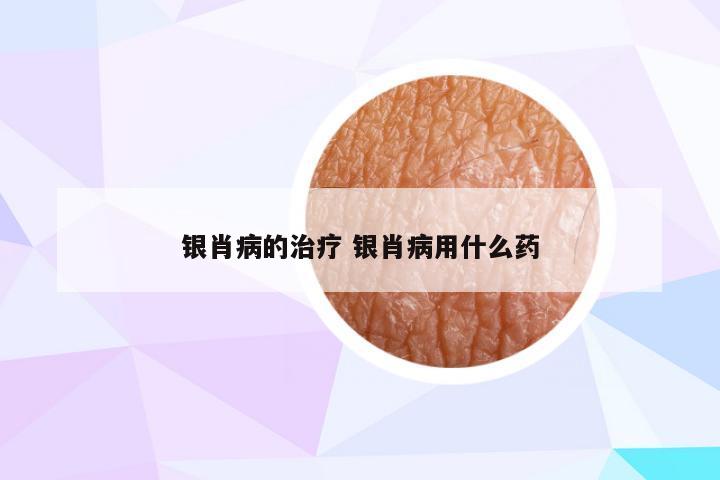 银肖病的治疗 银肖病用什么药