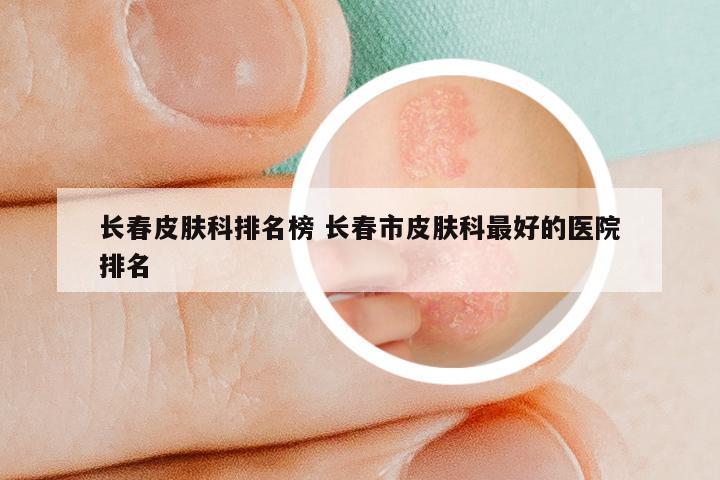 长春皮肤科排名榜 长春市皮肤科最好的医院排名