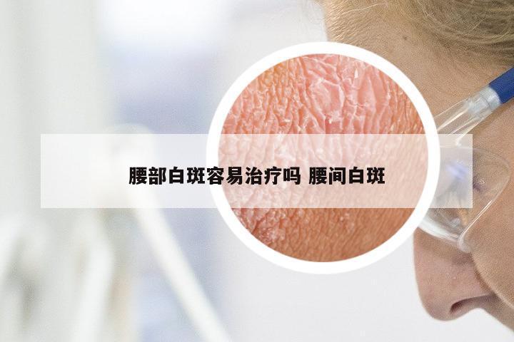 腰部白斑容易治疗吗 腰间白斑