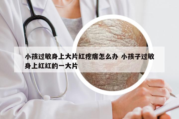 小孩过敏身上大片红疙瘩怎么办 小孩子过敏身上红红的一大片