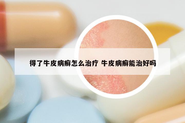 得了牛皮病癣怎么治疗 牛皮病癣能治好吗