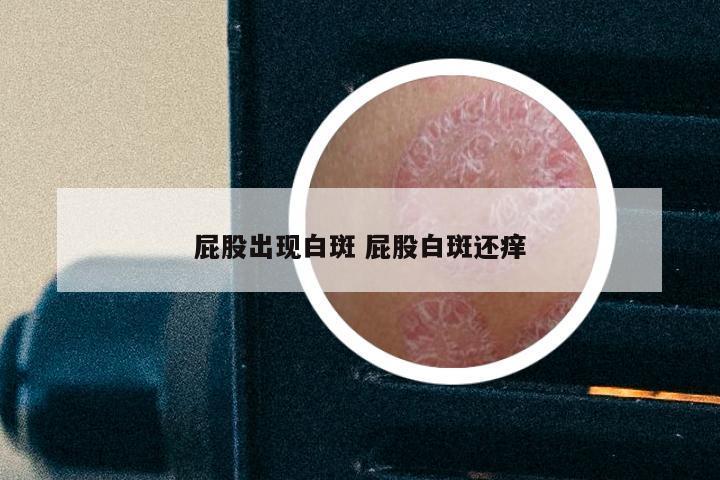 屁股出现白斑 屁股白斑还痒