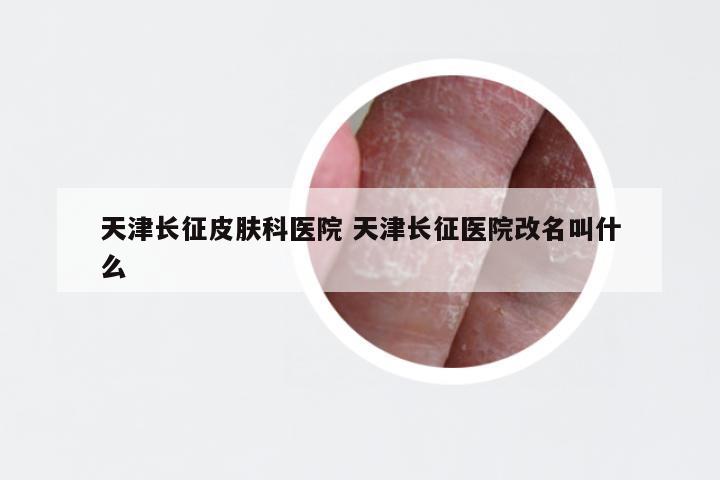 天津长征皮肤科医院 天津长征医院改名叫什么