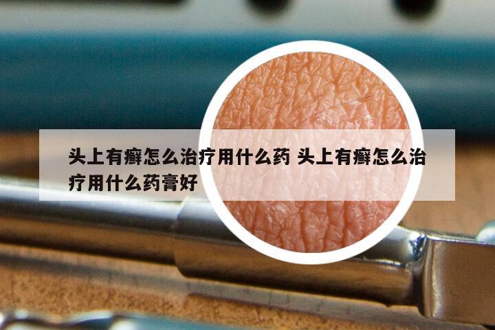 头上有癣怎么治疗用什么药 头上有癣怎么治疗用什么药膏好