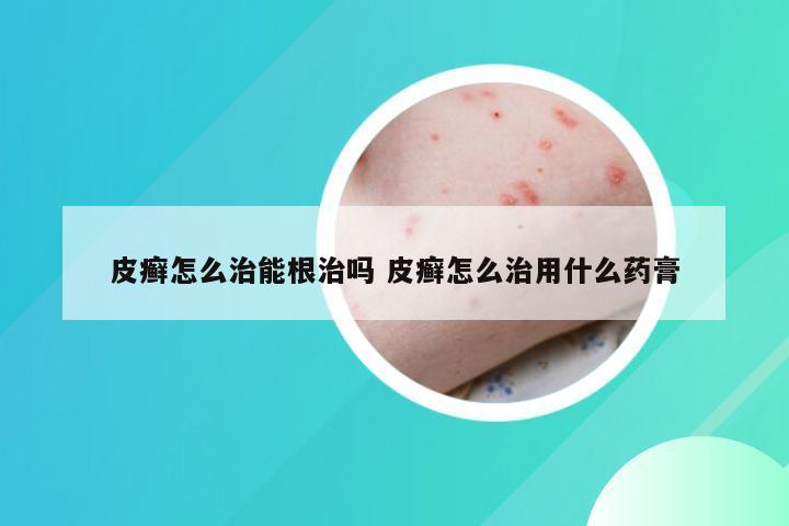 皮癣怎么治能根治吗 皮癣怎么治用什么药膏