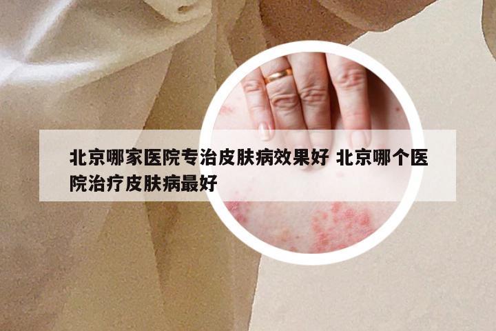 北京哪家医院专治皮肤病效果好 北京哪个医院治疗皮肤病最好