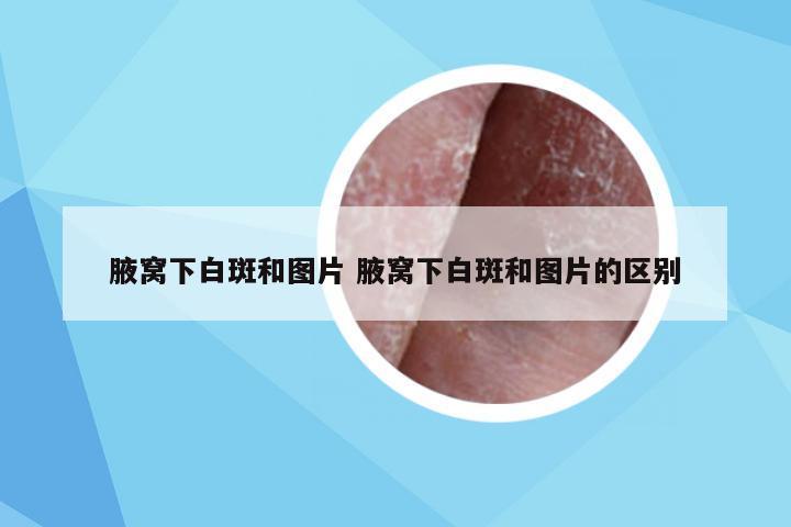 腋窝下白斑和图片 腋窝下白斑和图片的区别