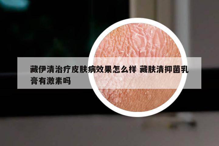 藏伊清治疗皮肤病效果怎么样 藏肤清抑菌乳膏有激素吗