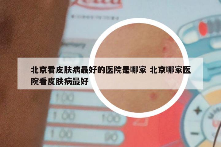 北京看皮肤病最好的医院是哪家 北京哪家医院看皮肤病最好