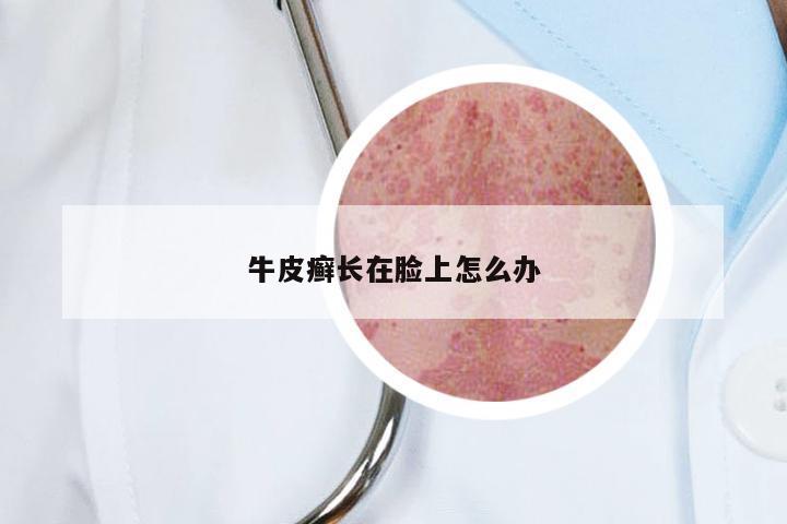 牛皮癣长在脸上怎么办