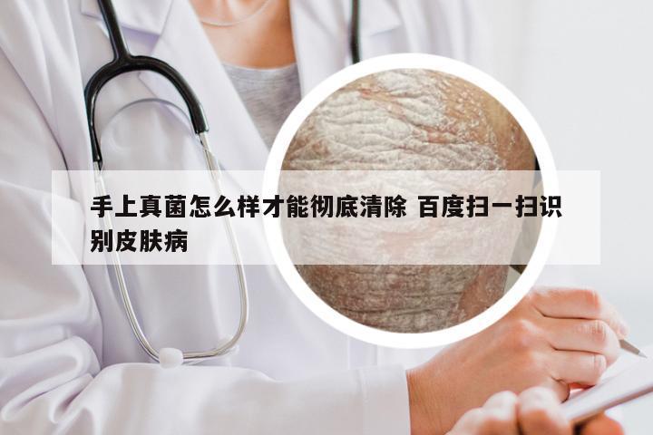 手上真菌怎么样才能彻底清除 百度扫一扫识别皮肤病