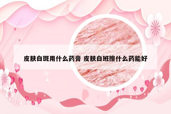 皮肤白斑用什么药膏 皮肤白班擦什么药能好