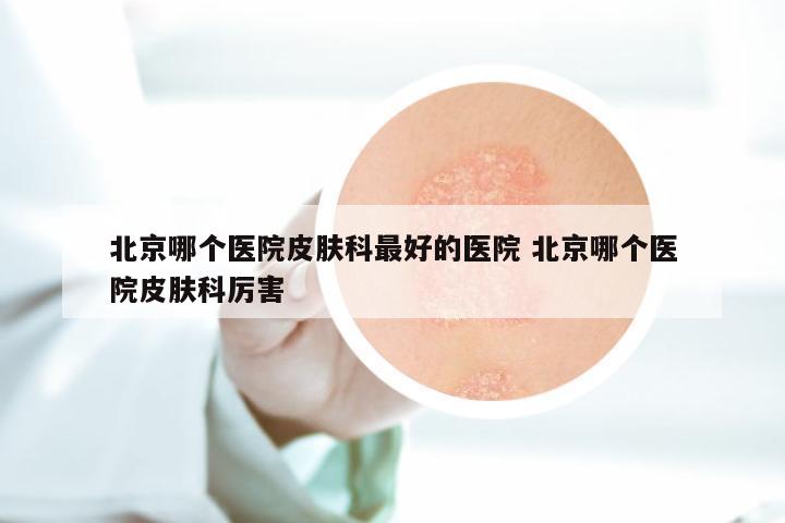 北京哪个医院皮肤科最好的医院 北京哪个医院皮肤科厉害