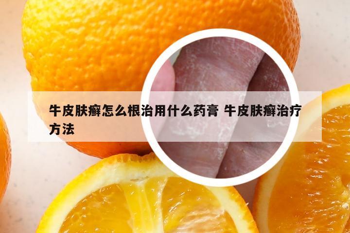 牛皮肤癣怎么根治用什么药膏 牛皮肤癣治疗方法