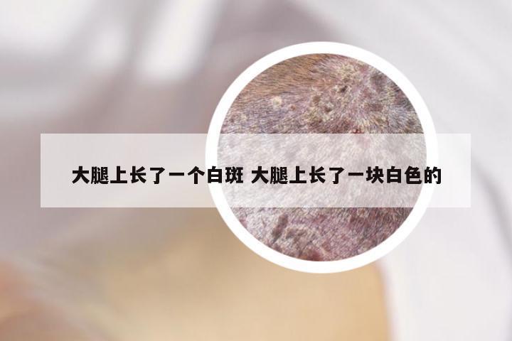 大腿上长了一个白斑 大腿上长了一块白色的