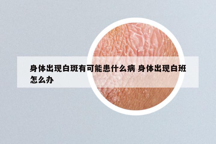 身体出现白斑有可能患什么病 身体出现白班怎么办