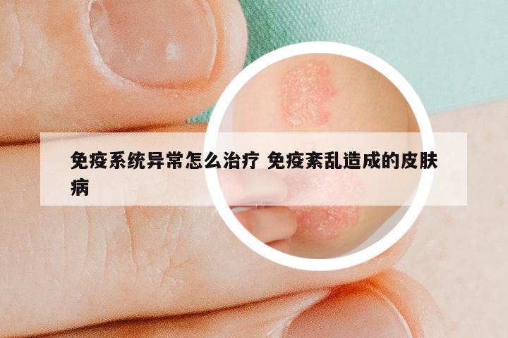 免疫系统异常怎么治疗 免疫紊乱造成的皮肤病