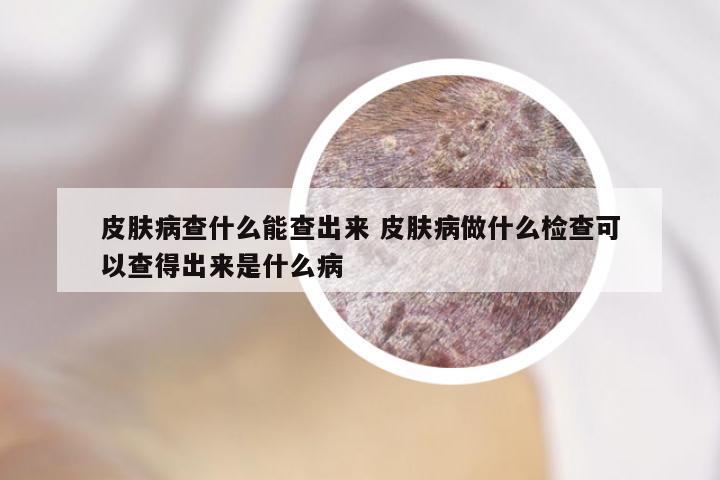 皮肤病查什么能查出来 皮肤病做什么检查可以查得出来是什么病