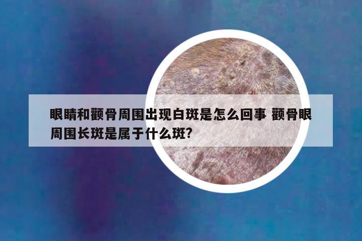 眼睛和颧骨周围出现白斑是怎么回事 颧骨眼周围长斑是属于什么斑?