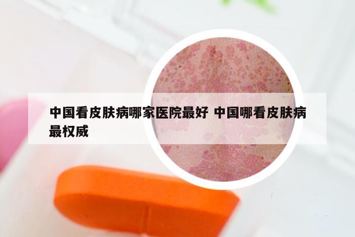 中国看皮肤病哪家医院最好 中国哪看皮肤病最权威