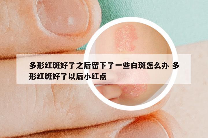 多形红斑好了之后留下了一些白斑怎么办 多形红斑好了以后小红点