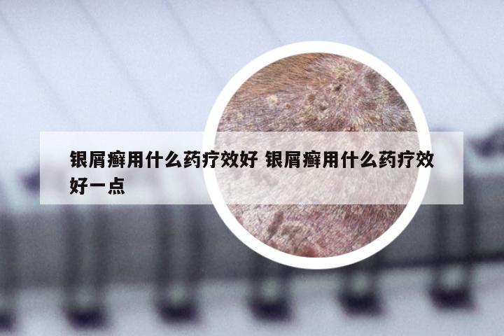 银屑癣用什么药疗效好 银屑癣用什么药疗效好一点