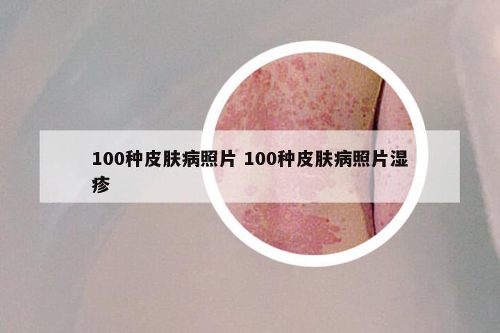 100种皮肤病照片 100种皮肤病照片湿疹