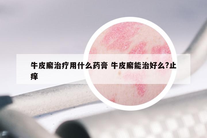 牛皮廨治疗用什么药膏 牛皮廨能治好么?止痒