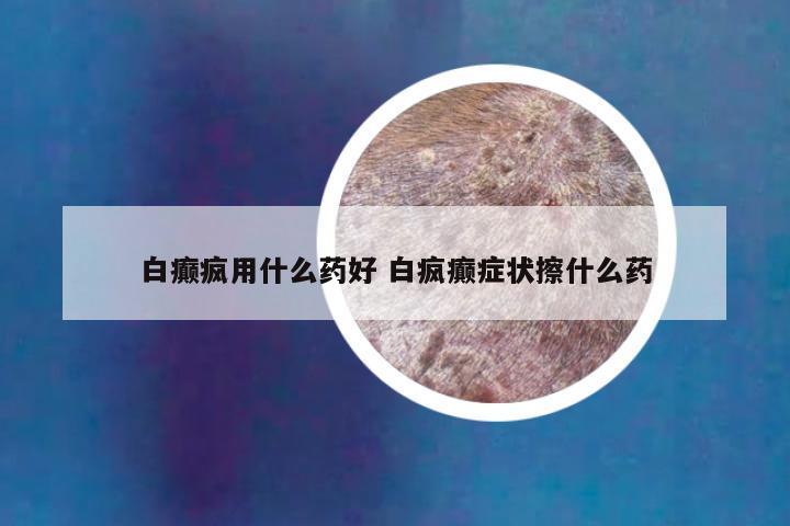 白癫疯用什么药好 白疯癫症状擦什么药