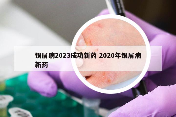银屑病2023成功新药 2020年银屑病新药