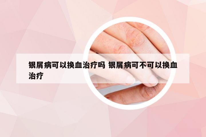 银屑病可以换血治疗吗 银屑病可不可以换血治疗