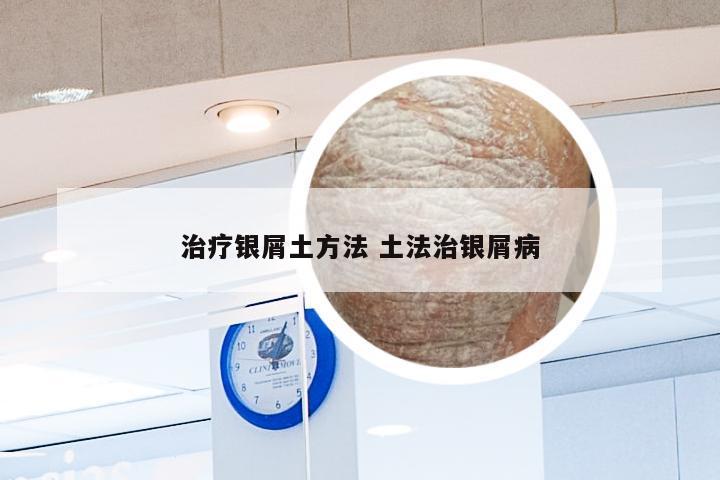 治疗银屑土方法 土法治银屑病