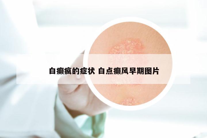 白癫疯的症状 白点癫风早期图片