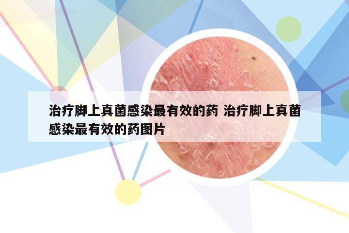 治疗脚上真菌感染最有效的药 治疗脚上真菌感染最有效的药图片