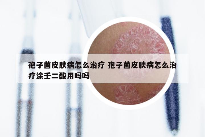 孢子菌皮肤病怎么治疗 孢子菌皮肤病怎么治疗涂壬二酸用吗吗