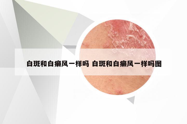 白斑和白癞风一样吗 白斑和白癞风一样吗图