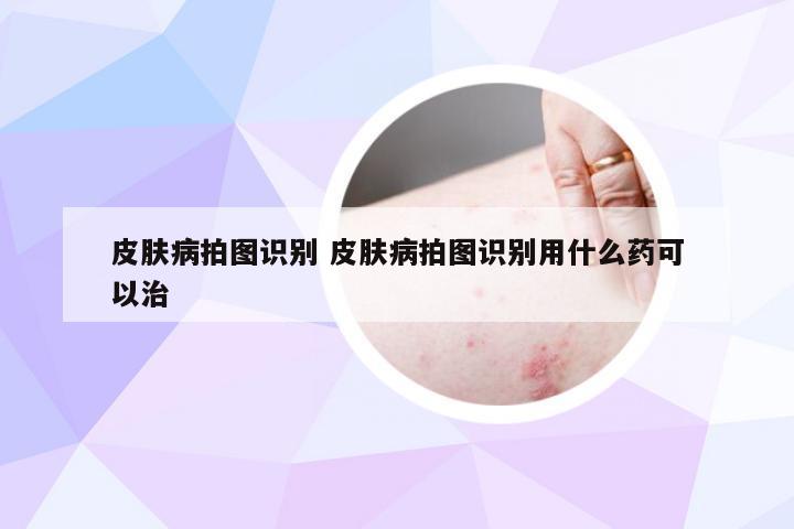 皮肤病拍图识别 皮肤病拍图识别用什么药可以治