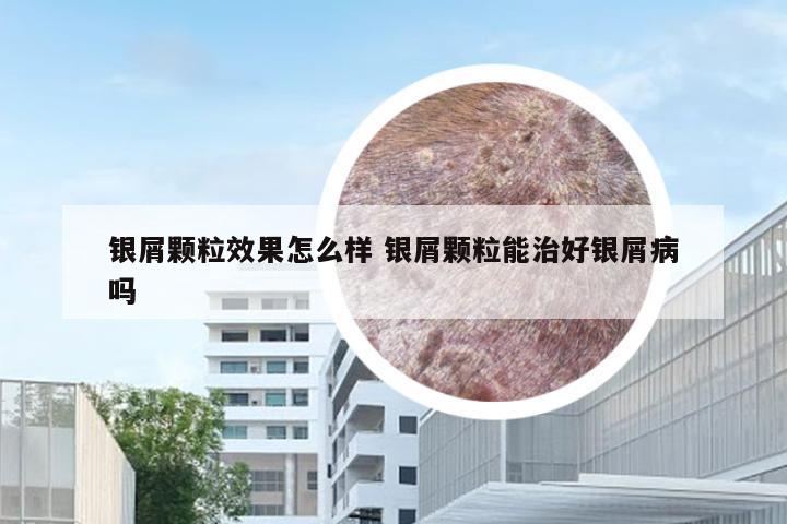 银屑颗粒效果怎么样 银屑颗粒能治好银屑病吗