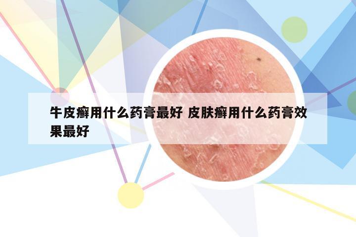 牛皮癣用什么药膏最好 皮肤癣用什么药膏效果最好